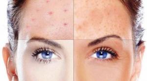 Раздражение на коже от пота Противовоспалительные маски – отличное средство в борьбе с раздражениями кожи лица