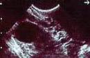 Четвертая неделя беременности: признаки и ощущения Выглядит эмбрион 4 5 недель